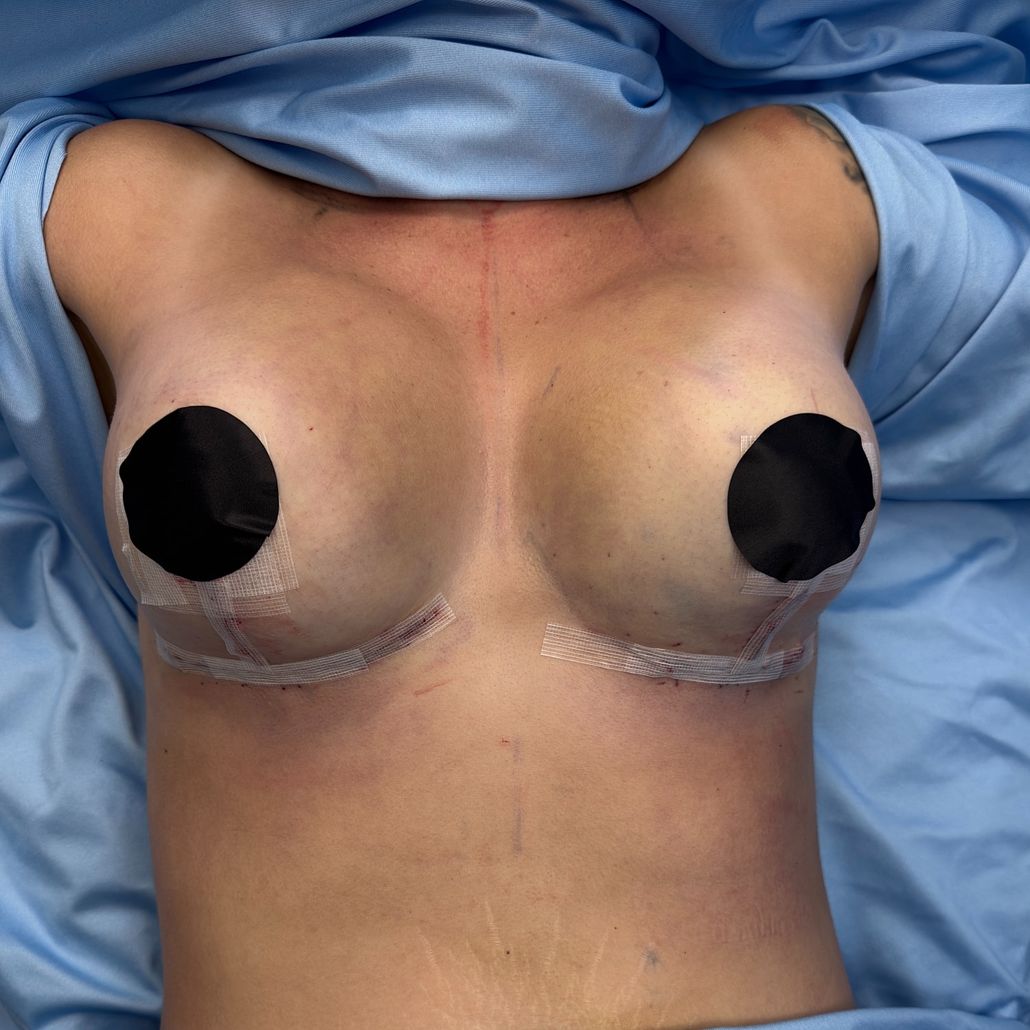 Post-surgery chest with protective covers.