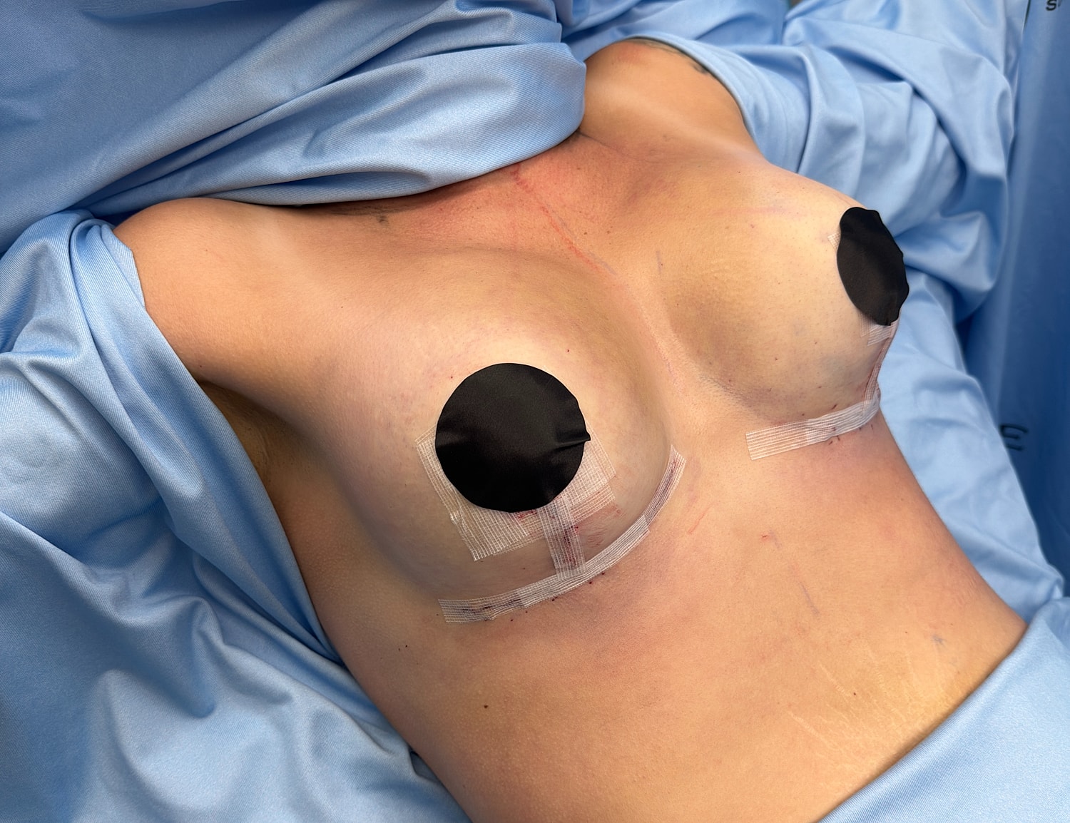 Surgical preparation with draped blue fabric.