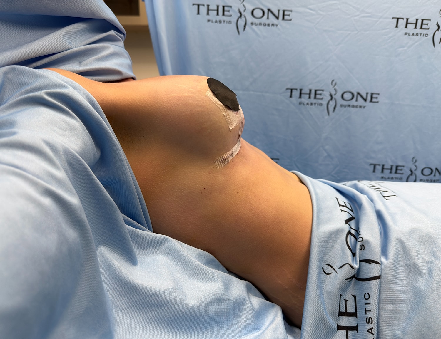 Post-operative view of breast surgery recovery.