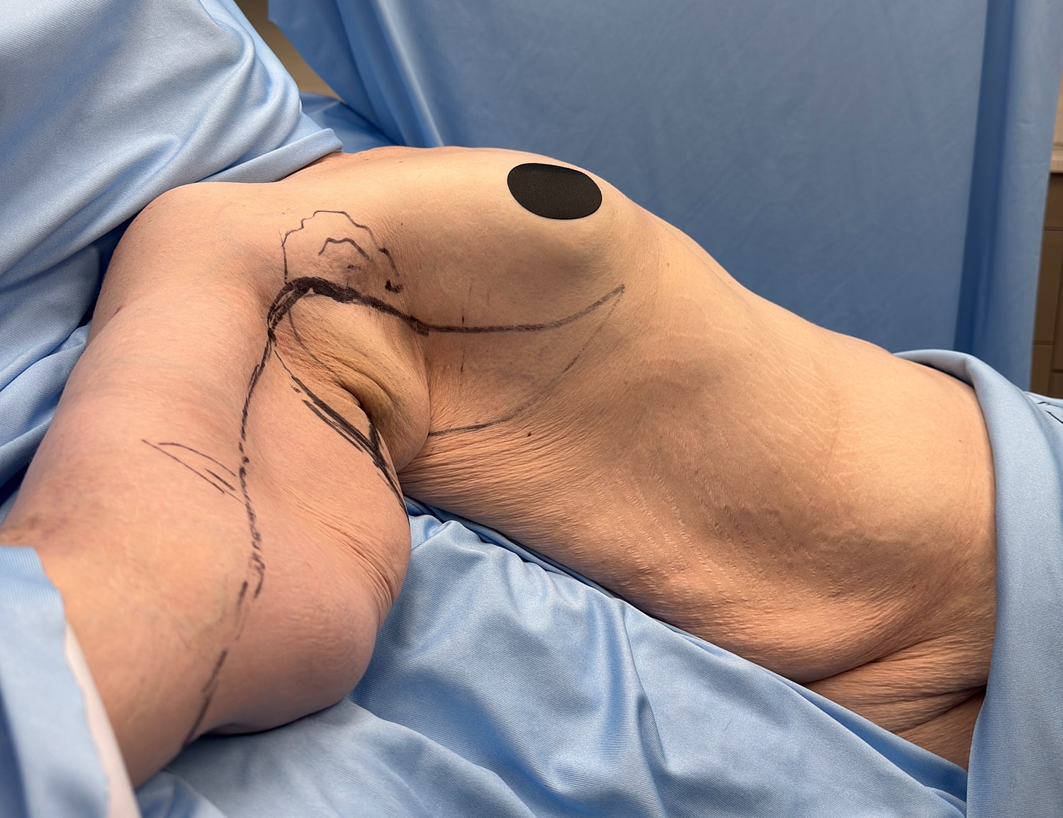 Surgical site with markings on the torso.