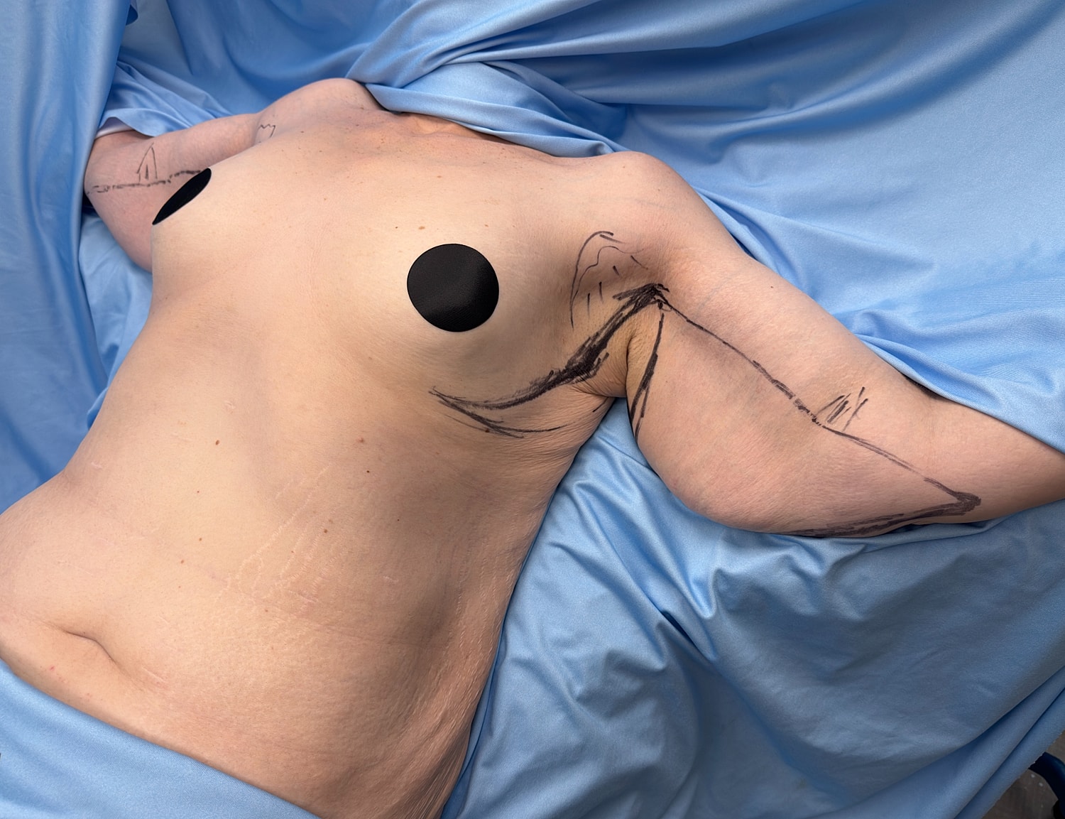 Body with markings under blue fabric.