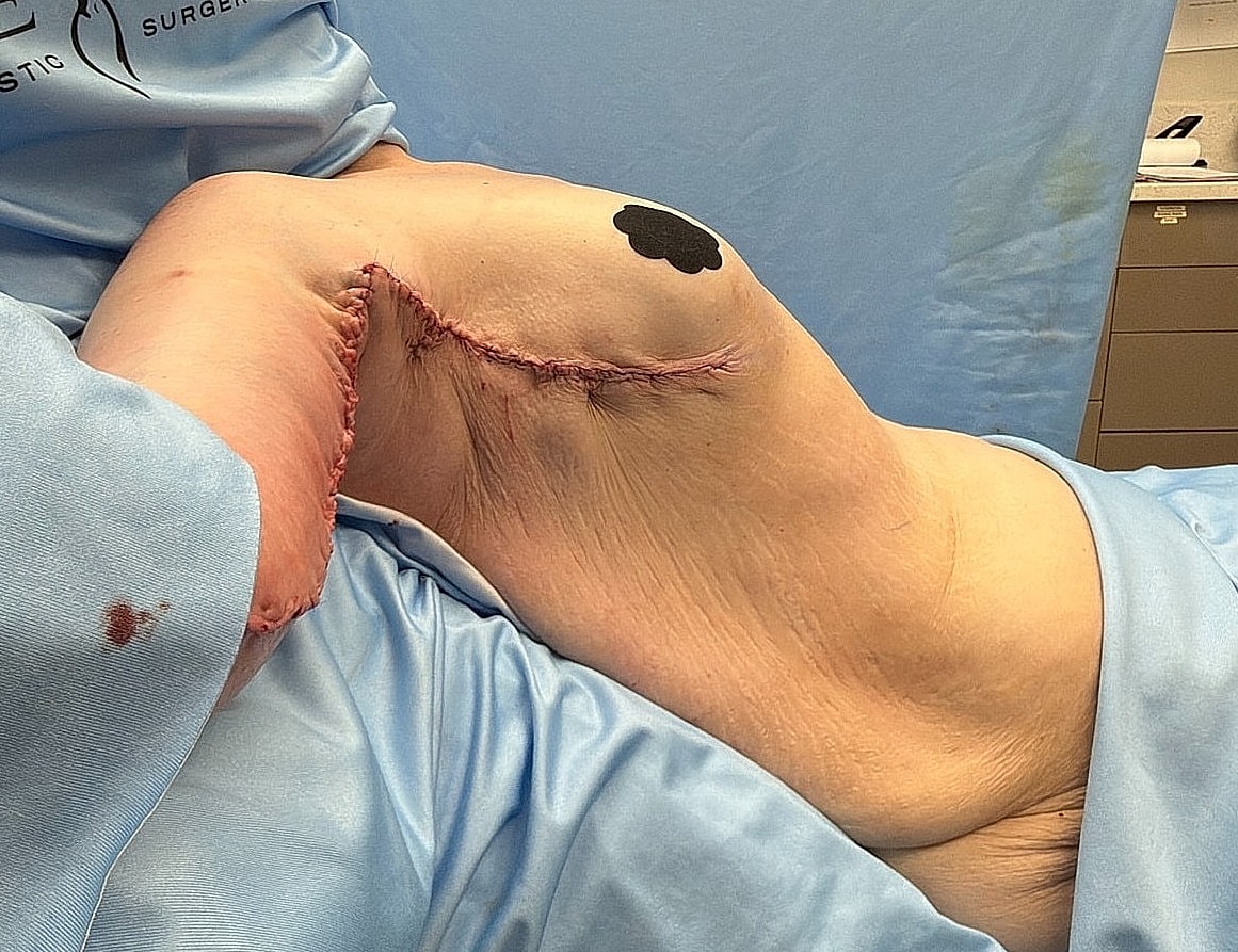 Post-surgery recovery with visible incision site.