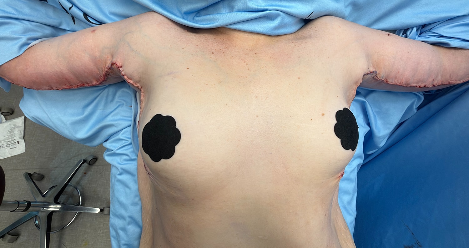 Post-surgical view of upper body and arms.