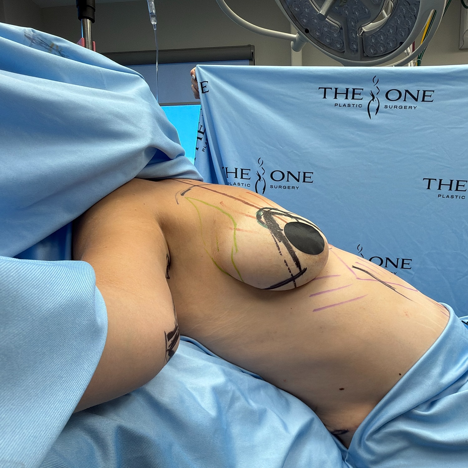 Surgical preparation for cosmetic procedure in progress