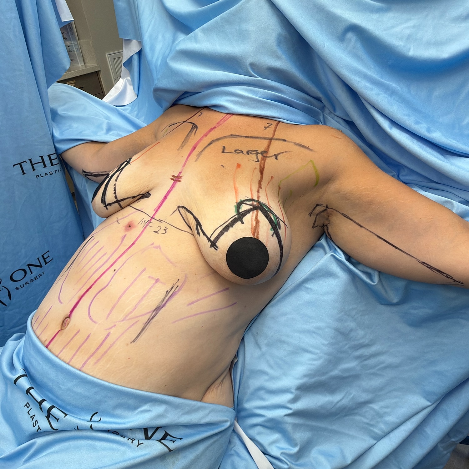 Pre-surgery markings on patient's torso and breasts.