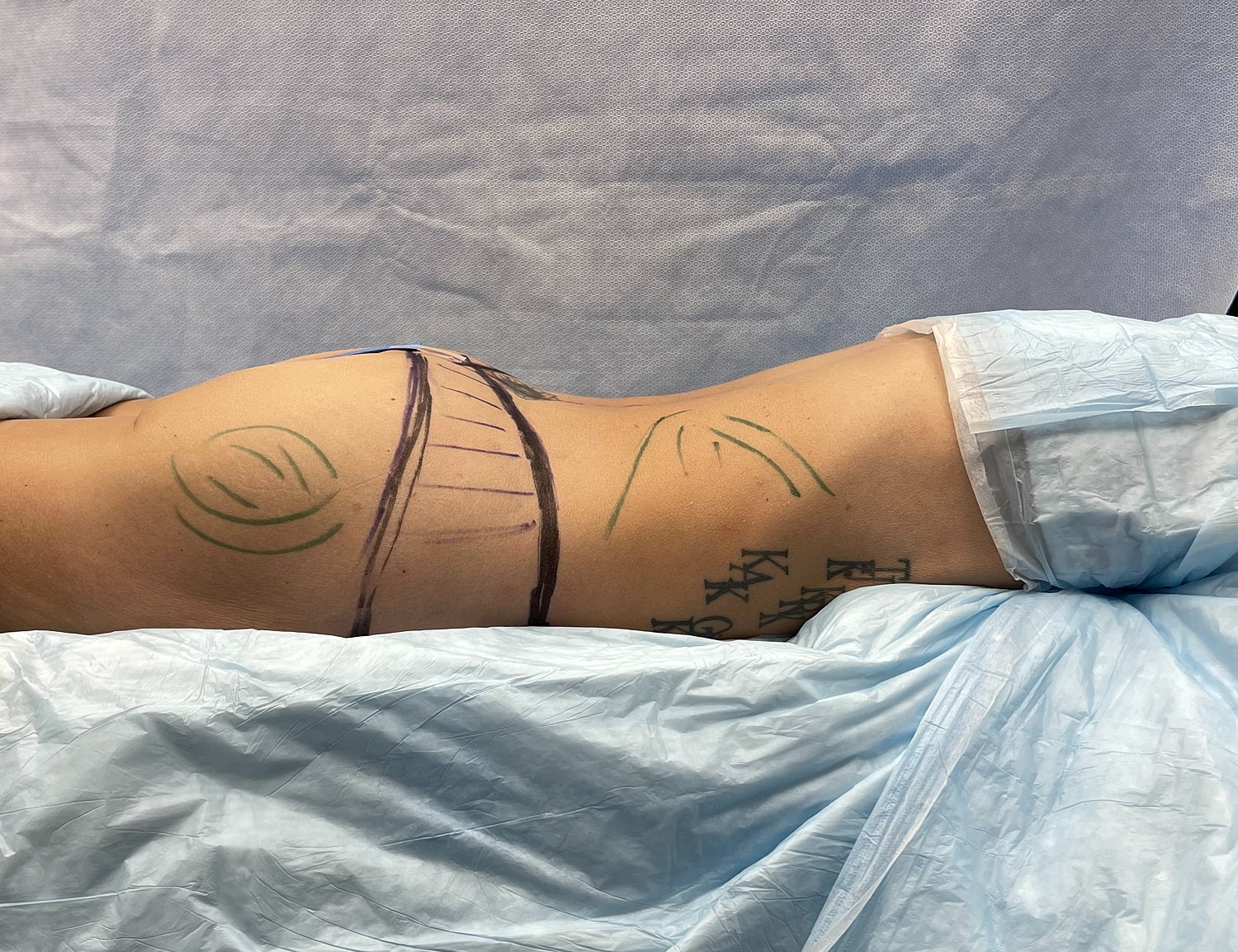 Marked skin preparation for cosmetic procedure.