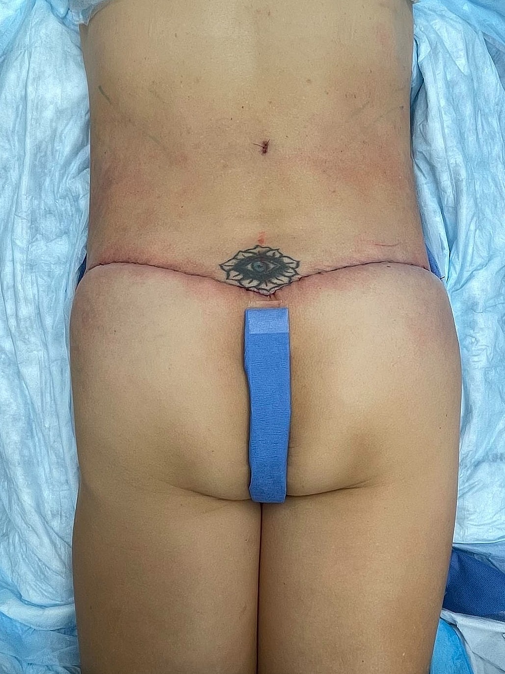 Patient lying on operating table with tattoo.