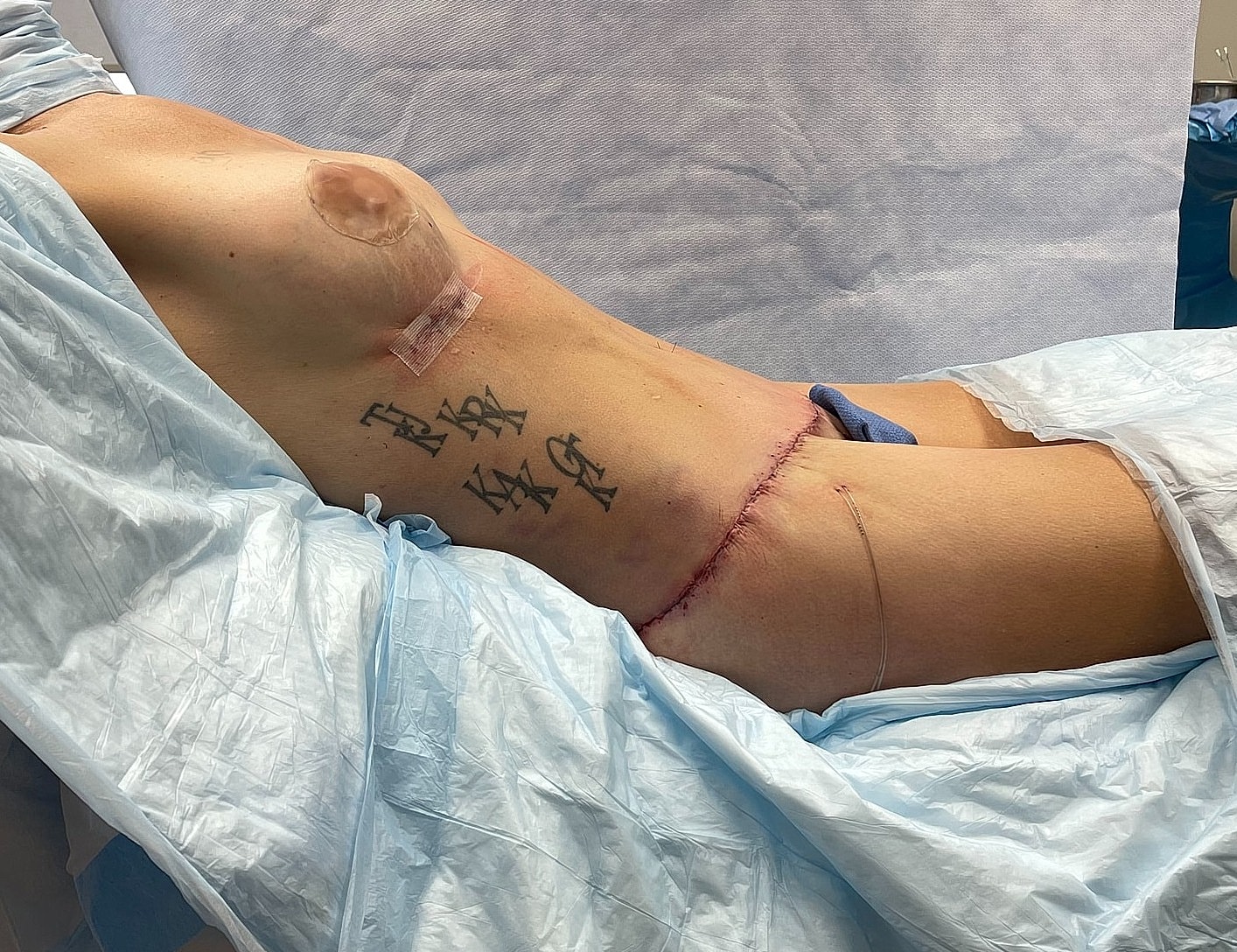 Post-surgery torso with bandages and tattoos.