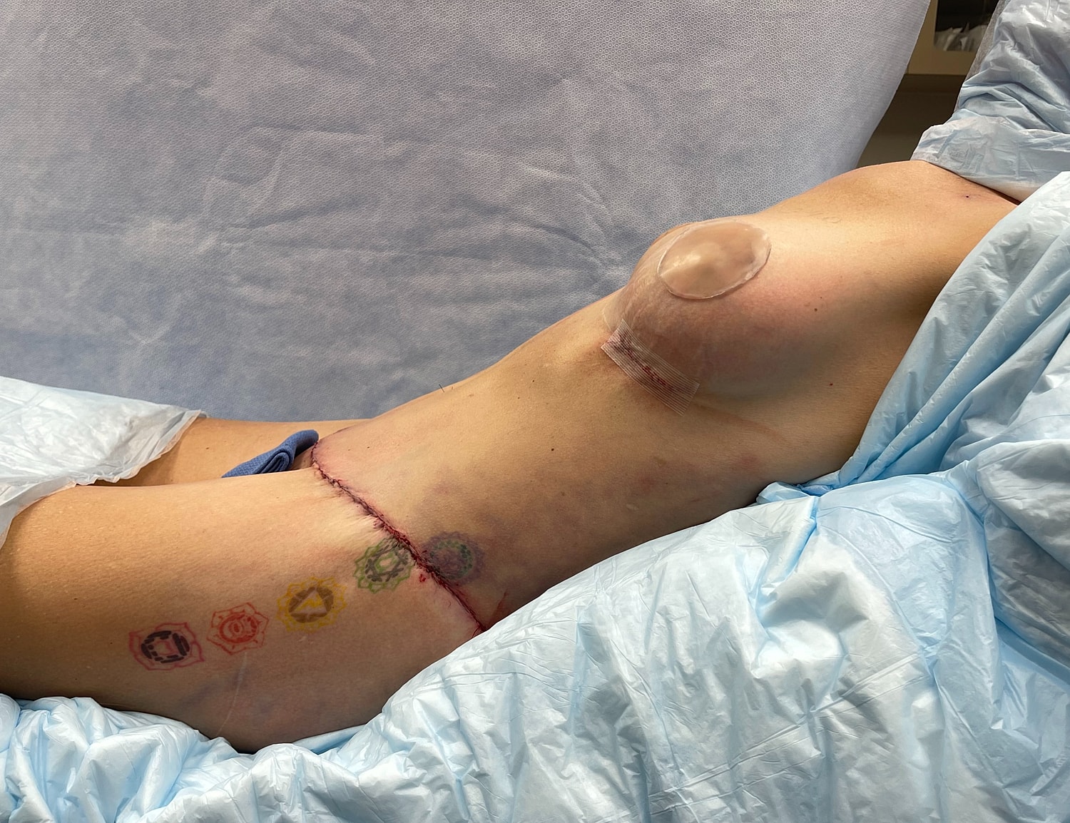Post-surgical body with tattoos and bandages.