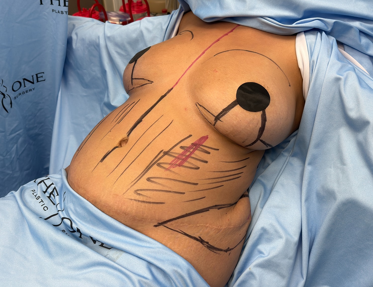 Pre-surgery markings on a patient's torso.