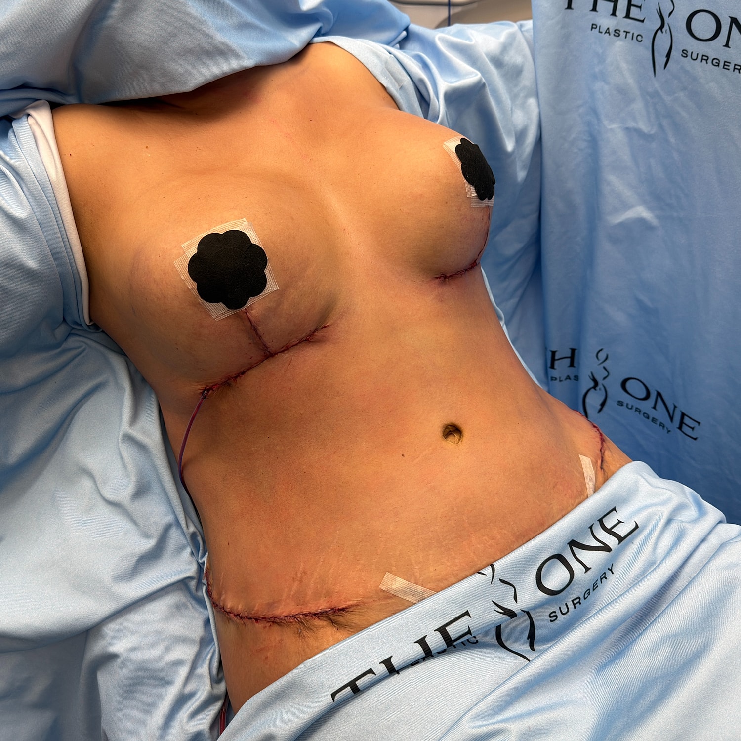 Post-surgery chest with dressings and sutures.