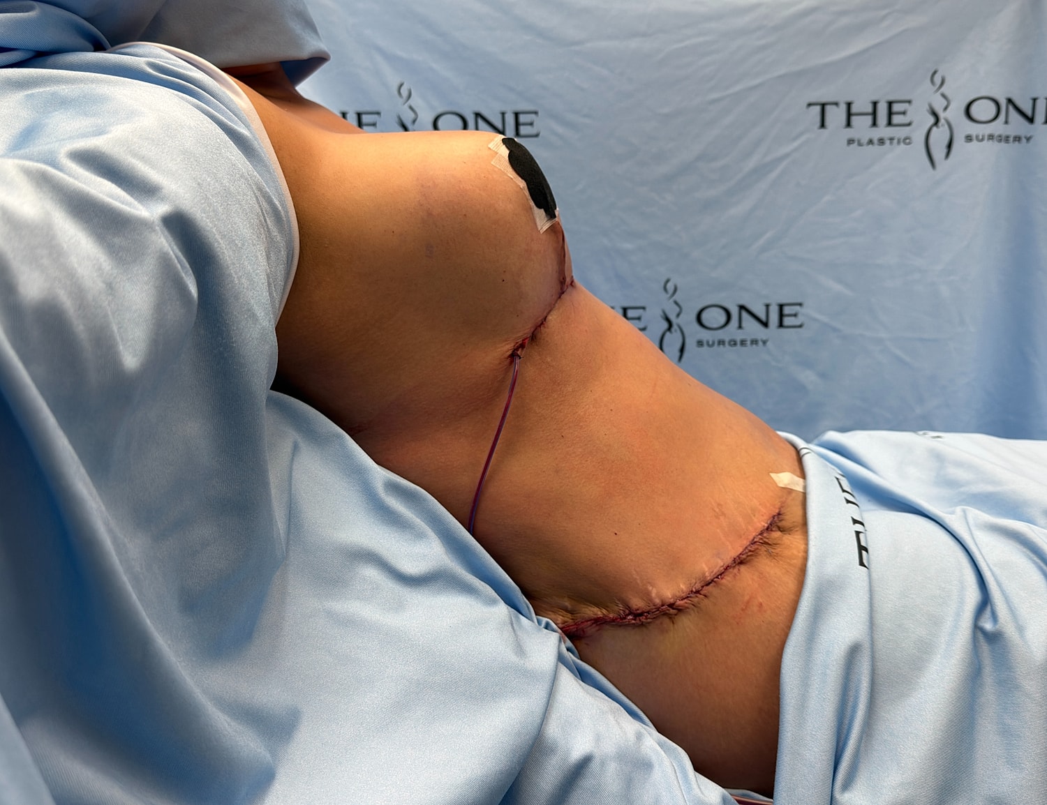 Post-operative surgical site on abdomen.