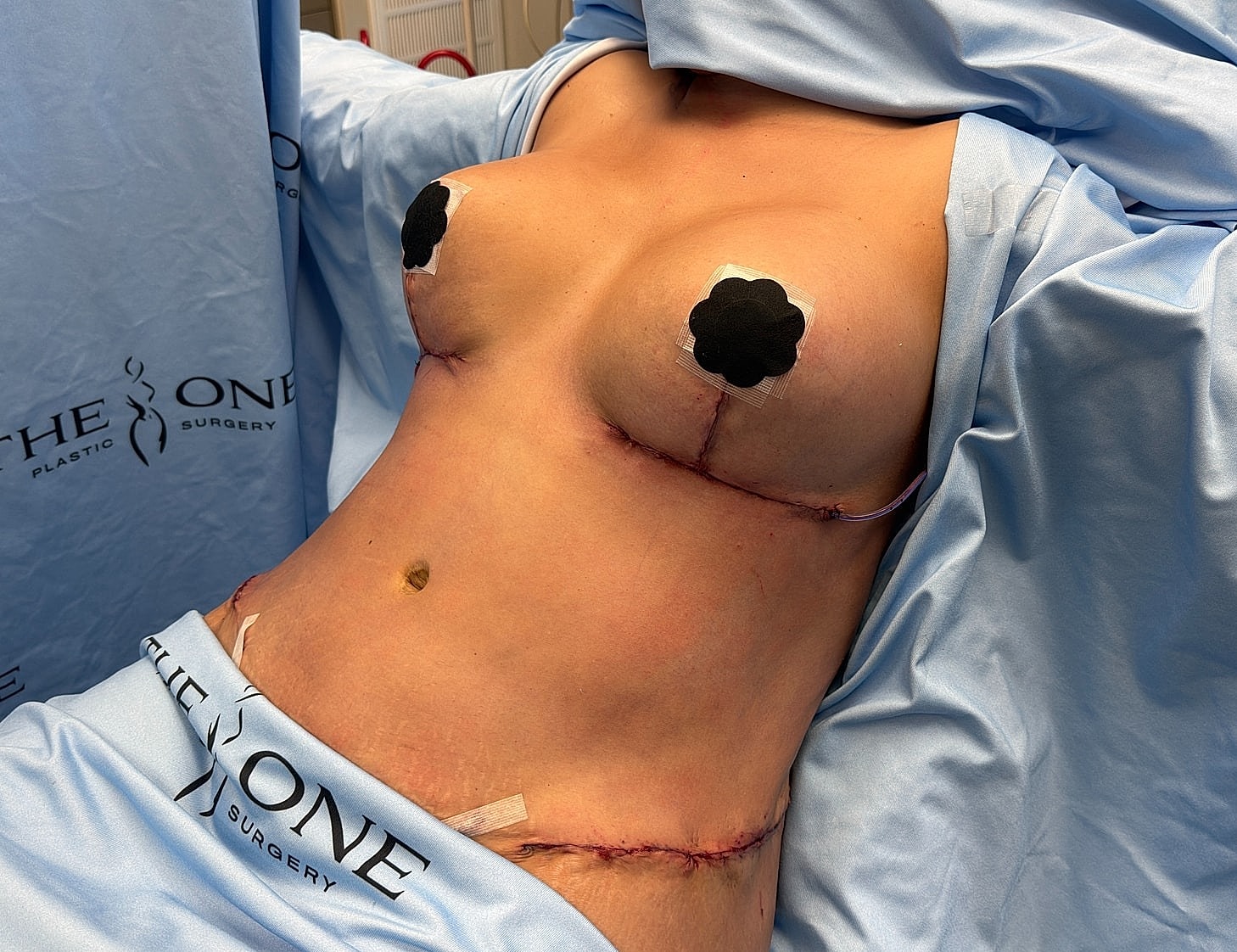 Post-surgery breast reconstruction with bandages.