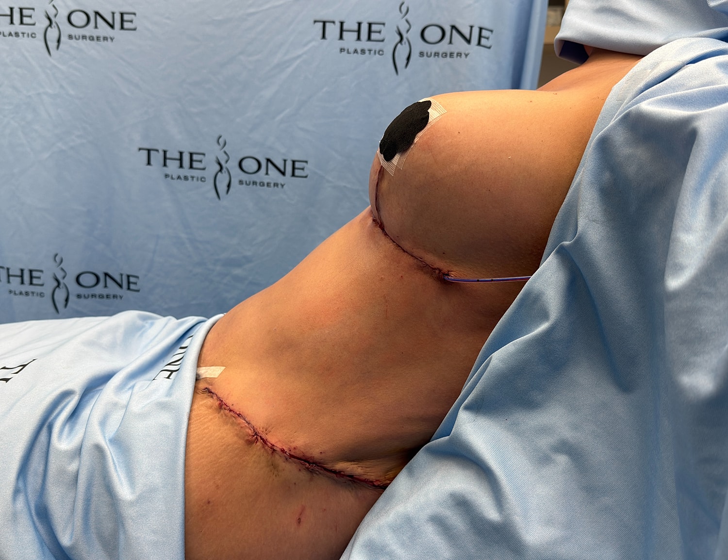 Post-surgical view of breast augmentation stitches.