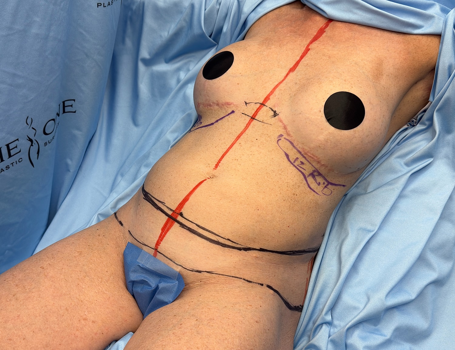 Patient pre-surgery markings on abdomen and chest.
