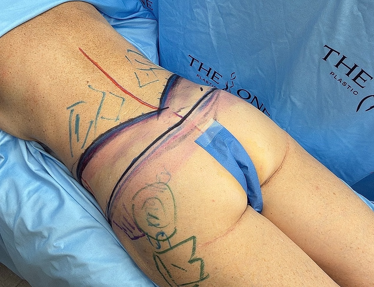 Patient prep for cosmetic surgery procedure.