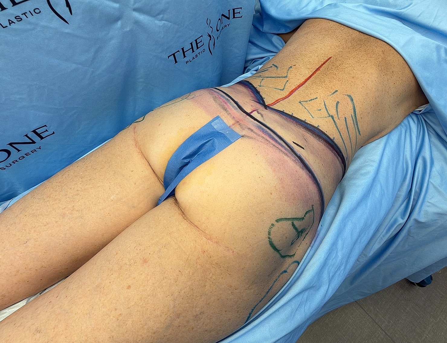 Surgical markings on patient's lower back area.