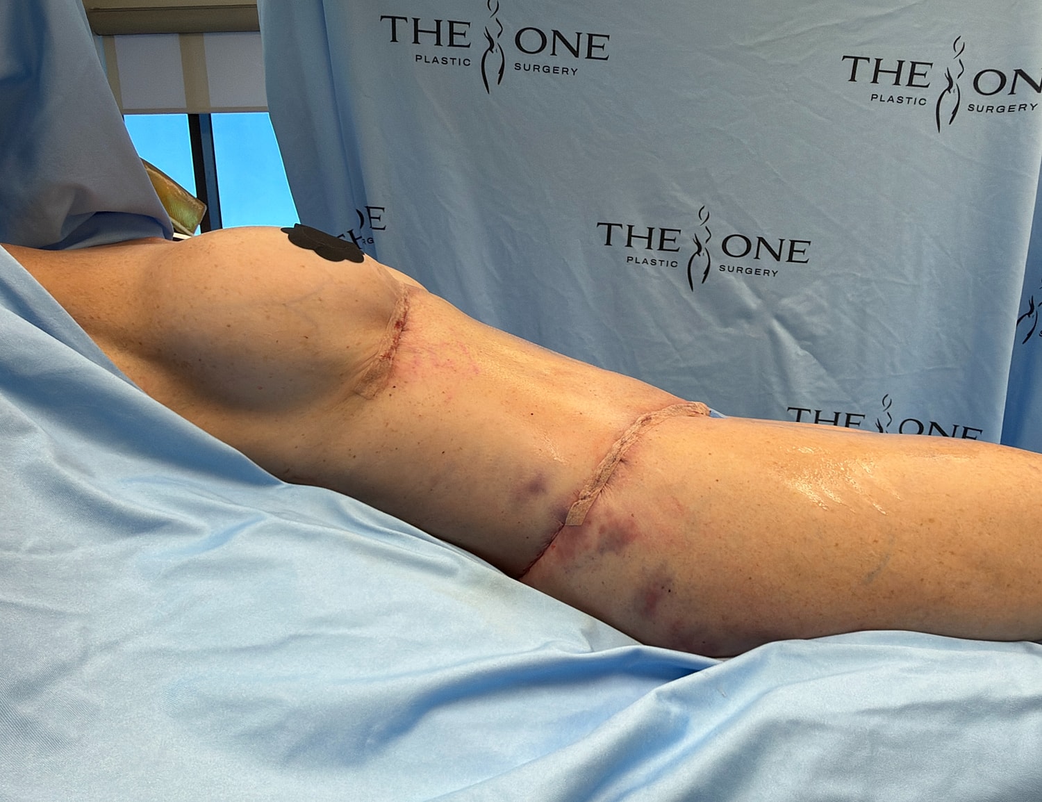 Post-surgery image of a patient’s side.
