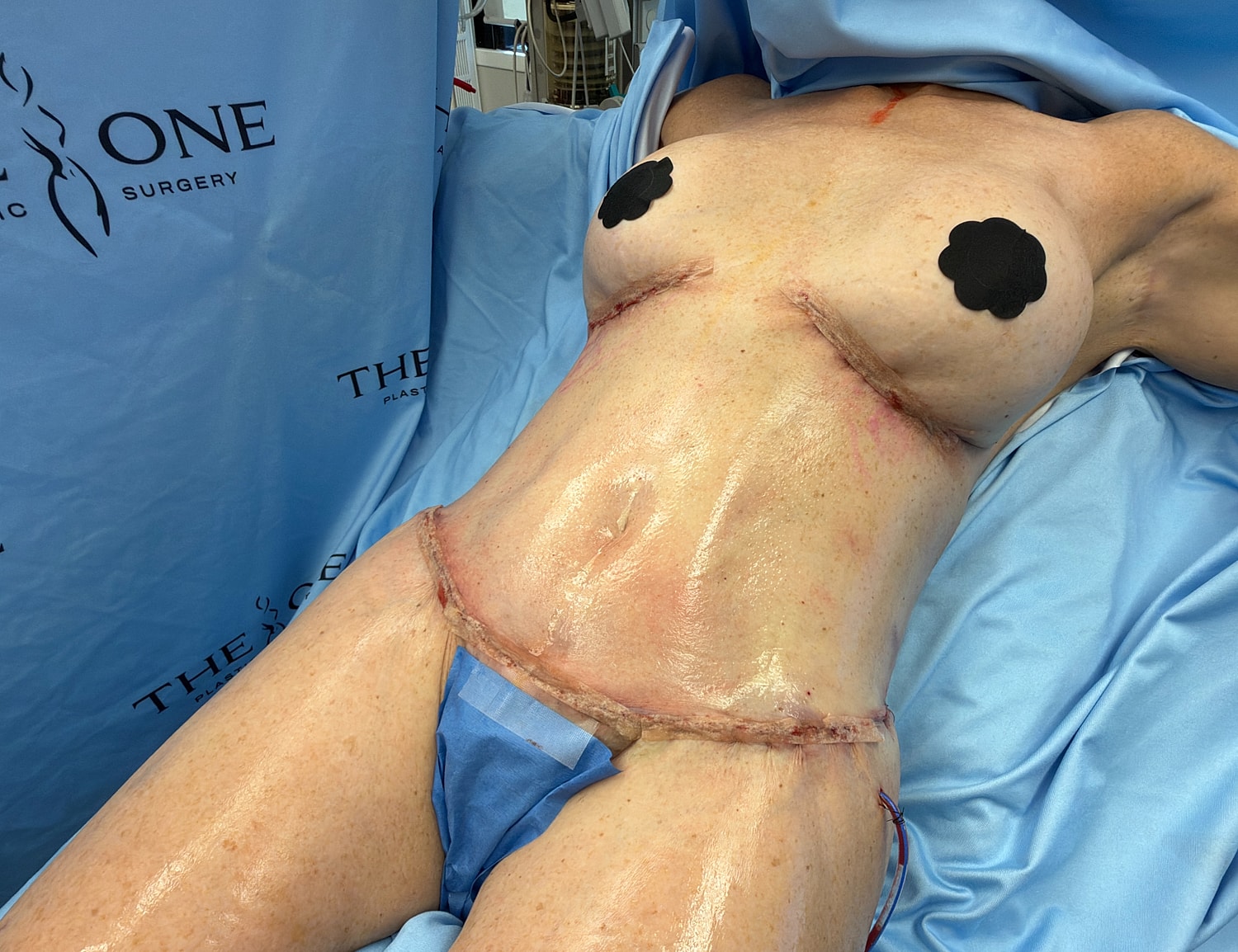 Post-surgery view of a female abdomen.