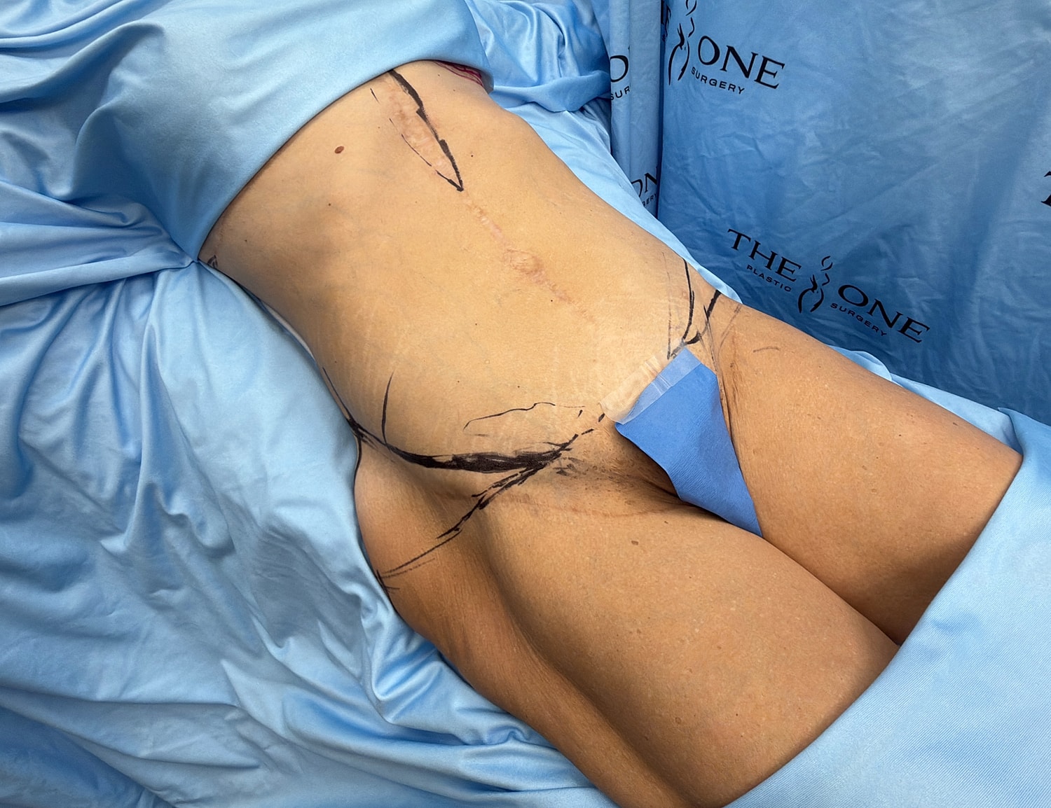 Patient preparation for surgical procedure on abdomen.