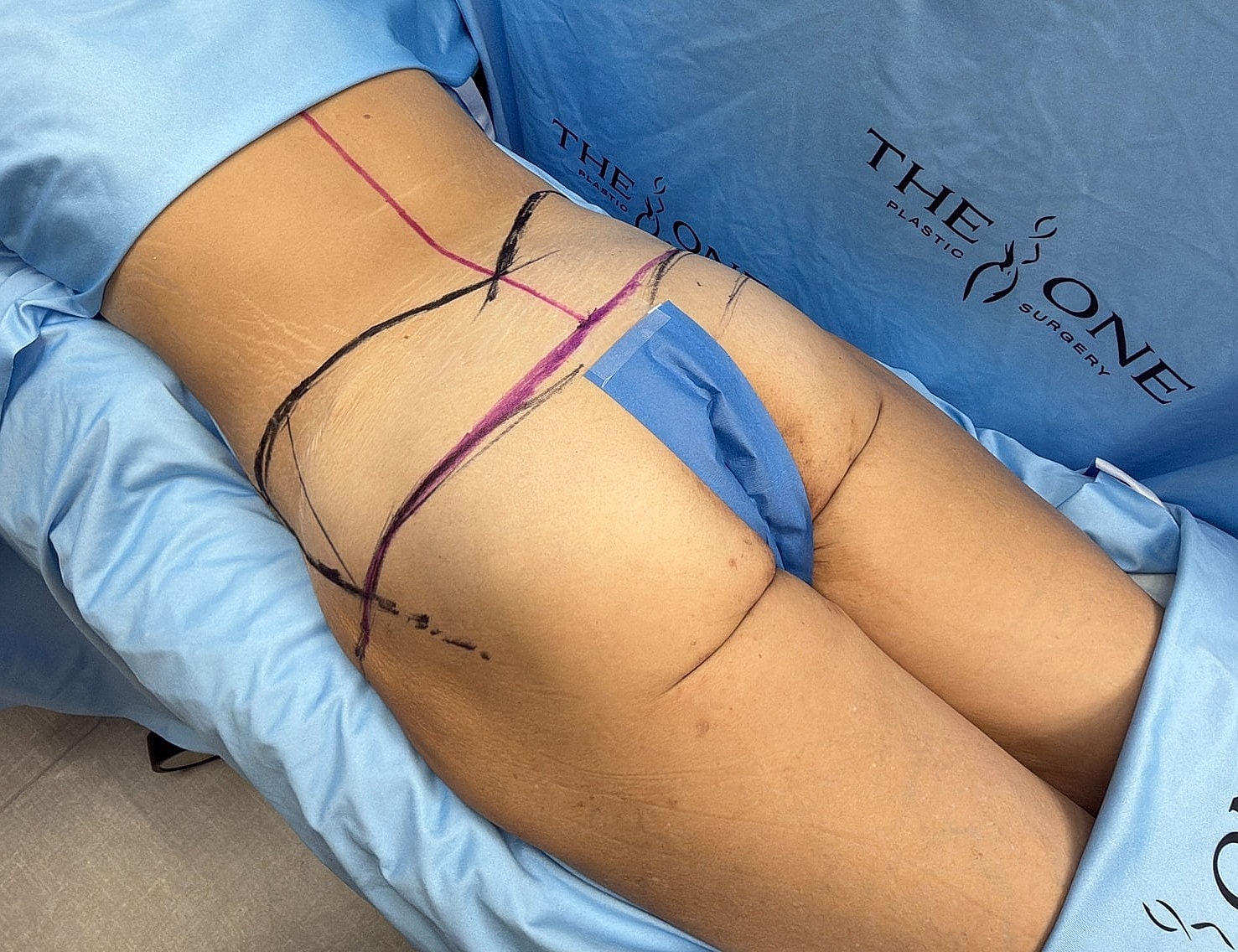 Surgical markings on patient for cosmetic procedure.