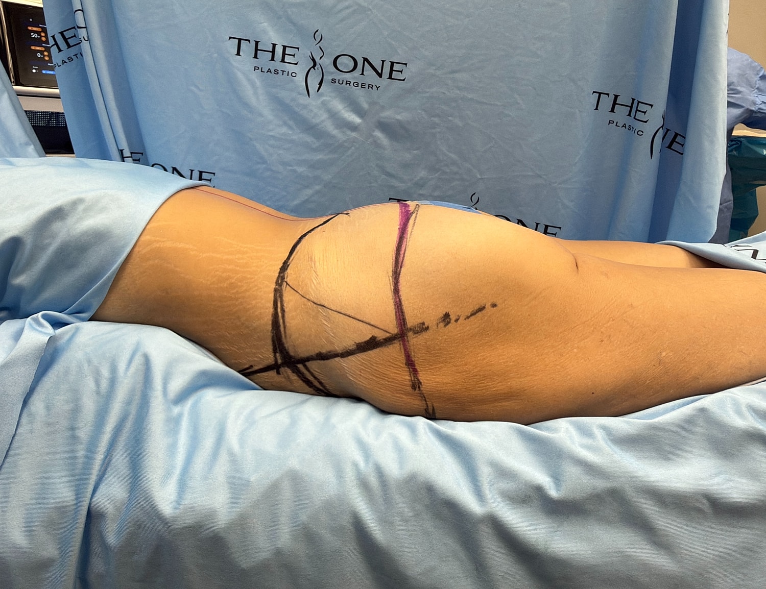 Patient preparing for plastic surgery procedure.
