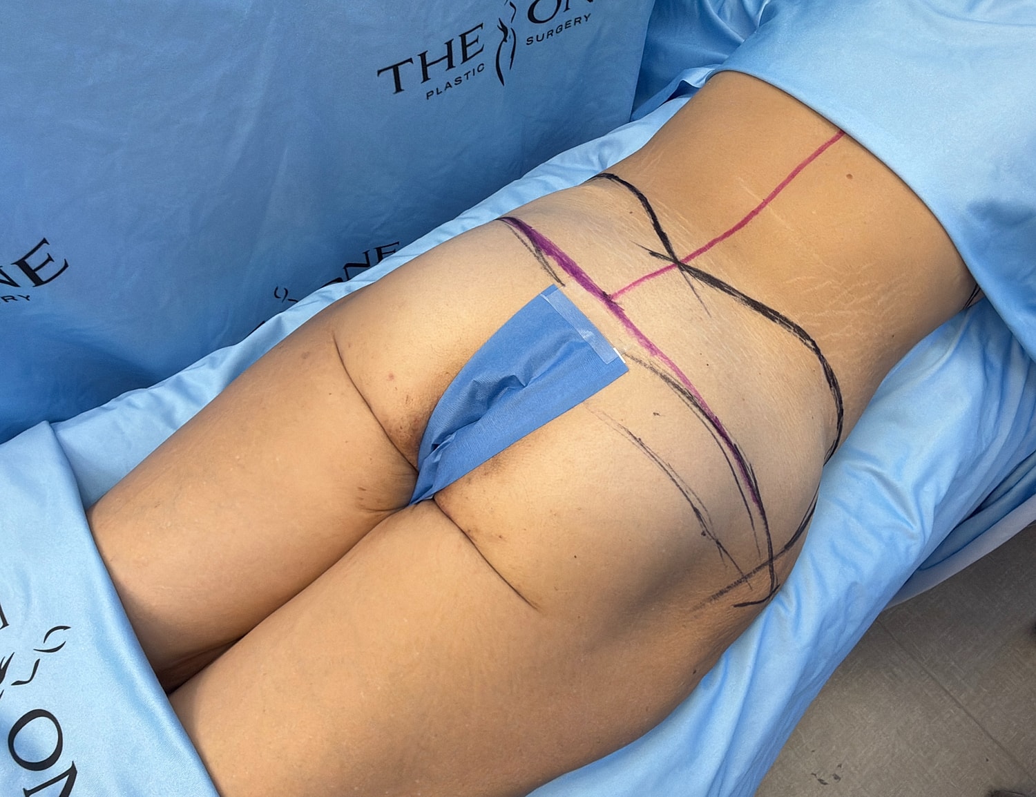 Surgical markings on patient for procedure preparation.