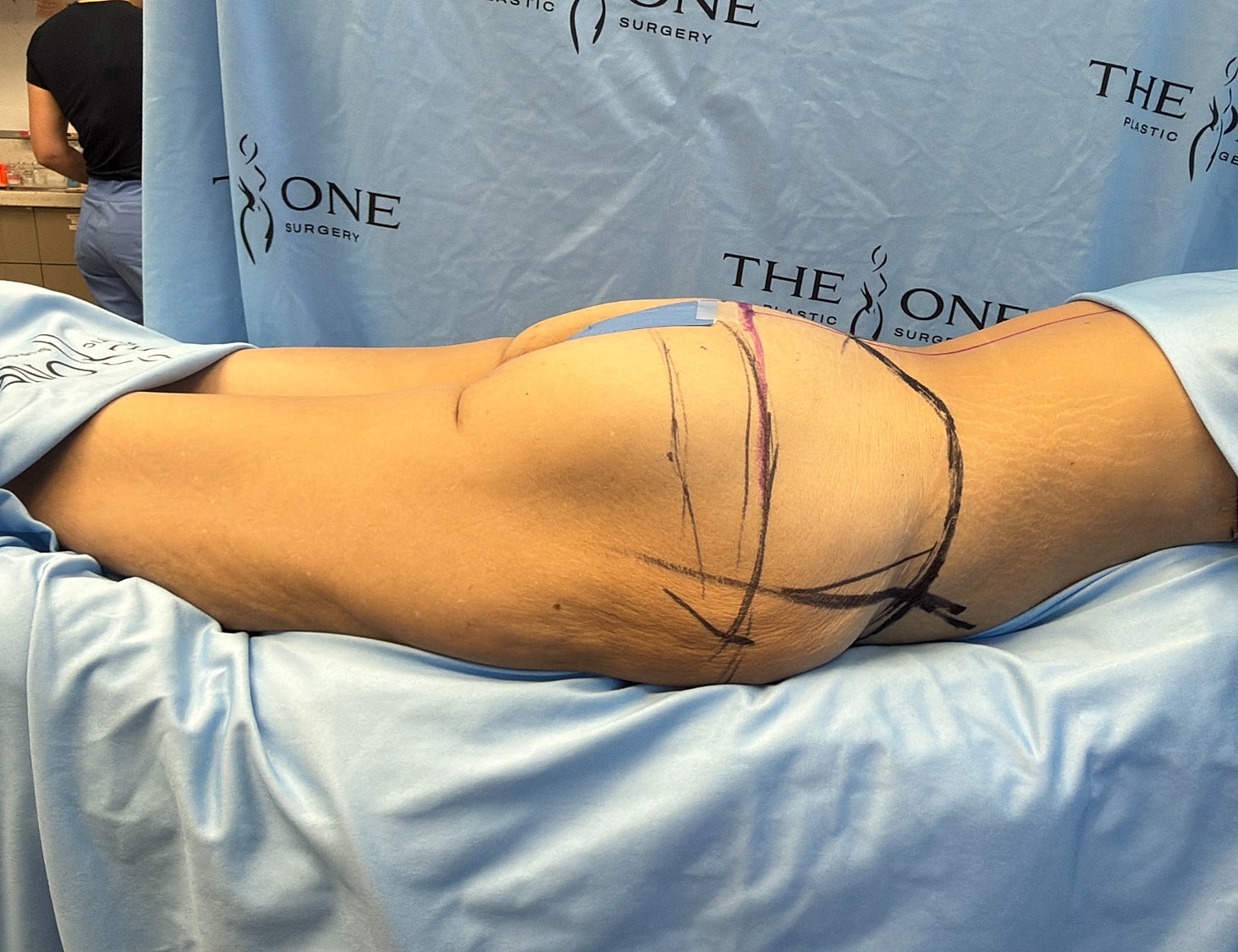Surgical markings on body in medical setting.