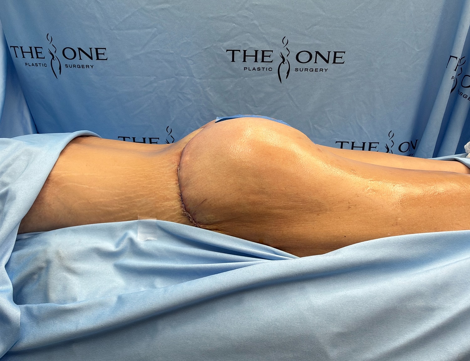 Surgical procedure on the thigh and buttock area