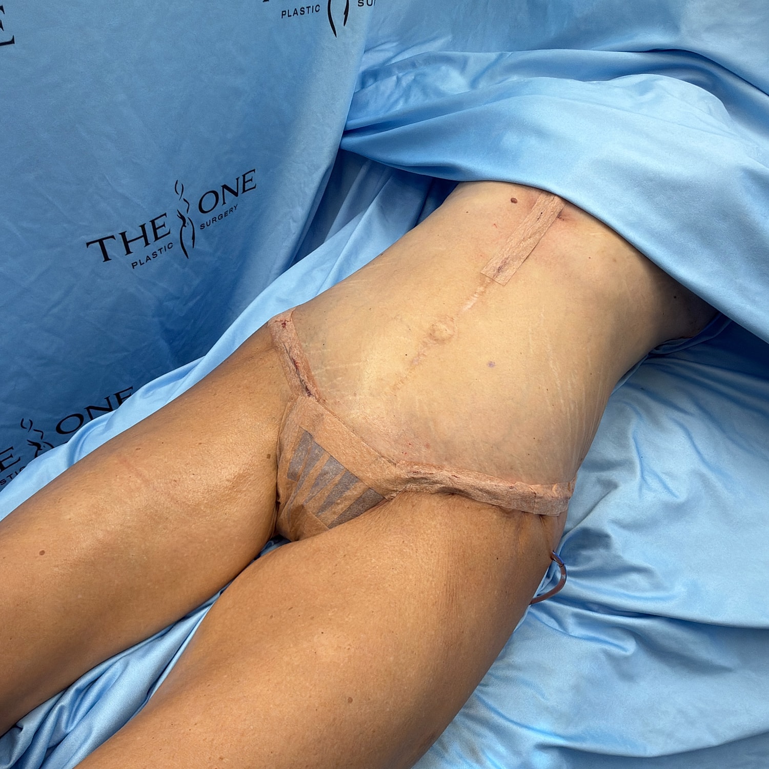 Post-surgery patient on an examination table.