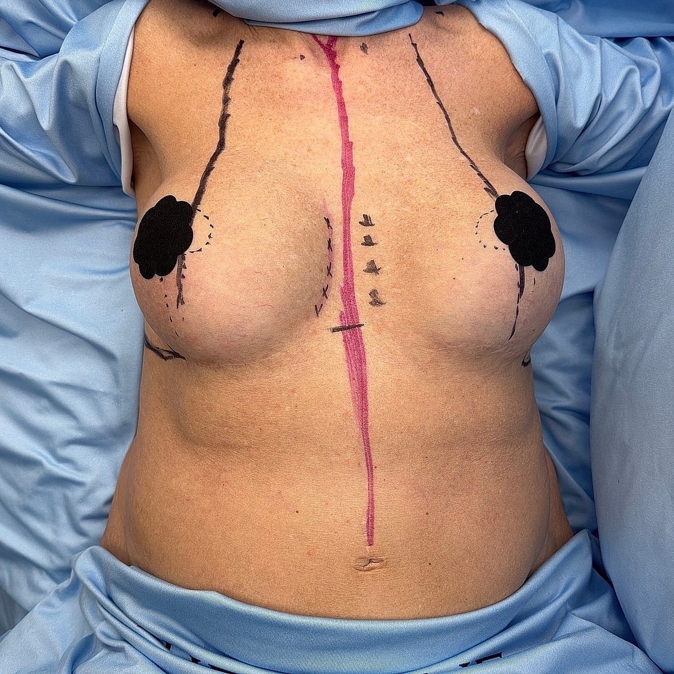 Medical markings on chest pre-surgery.