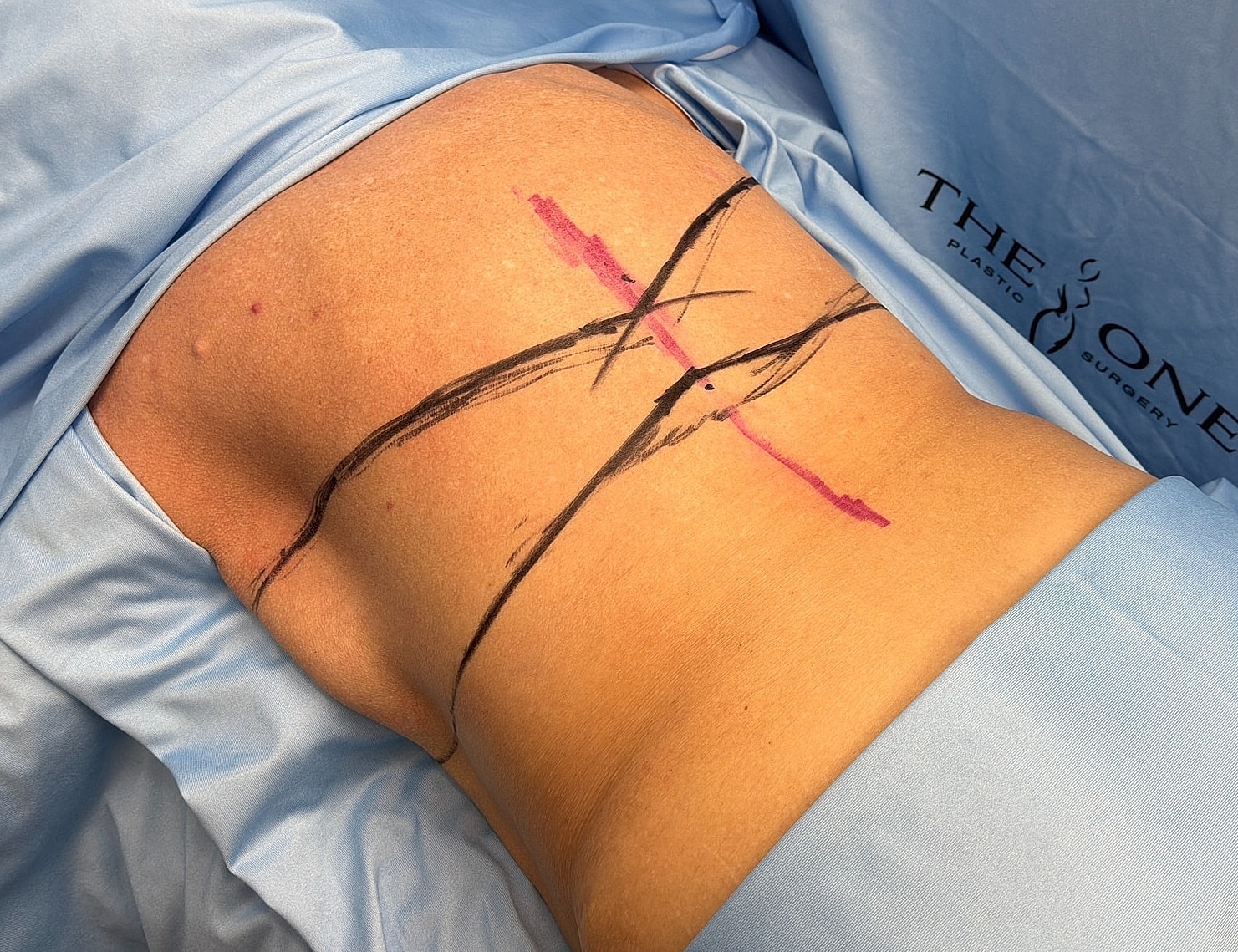 Pre-operative markings on patient's lower back.