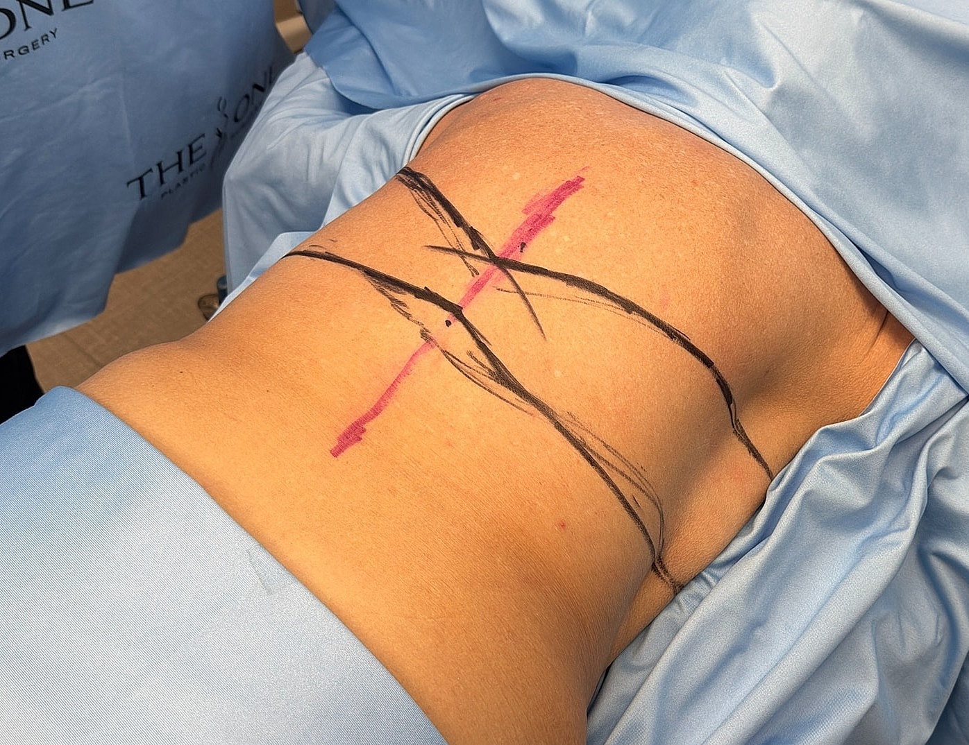 Pre-surgery markings on patient's back.