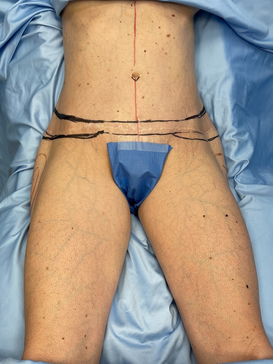 Surgical markings on patient’s abdomen and thighs.