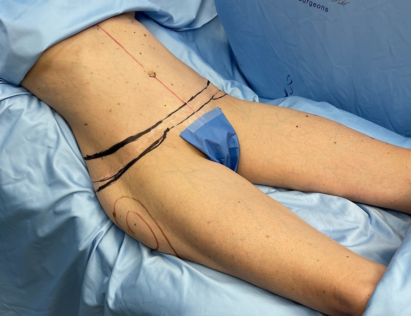Surgical markings on patient's thigh before procedure.
