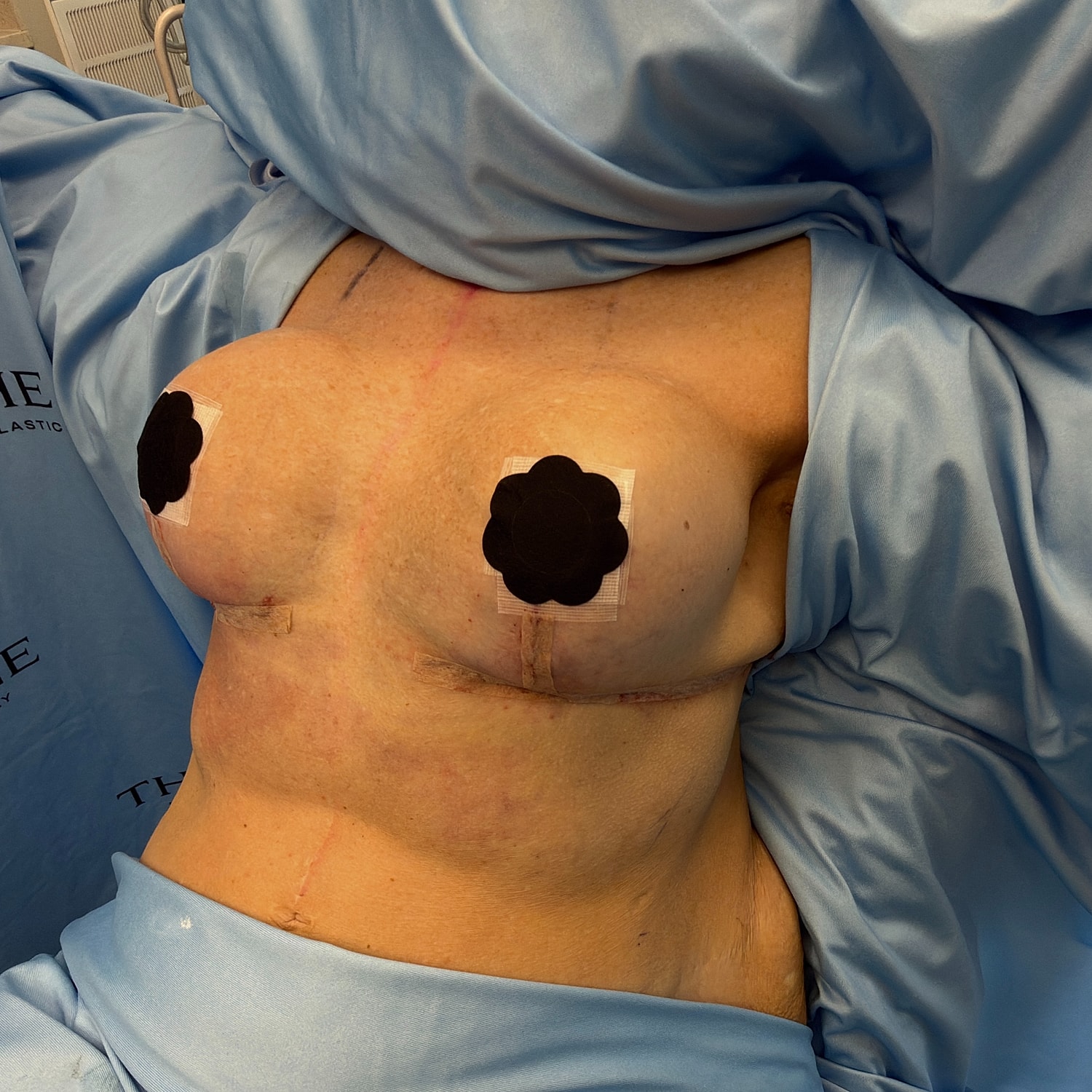 Post-surgery torso with dressings and drapery.