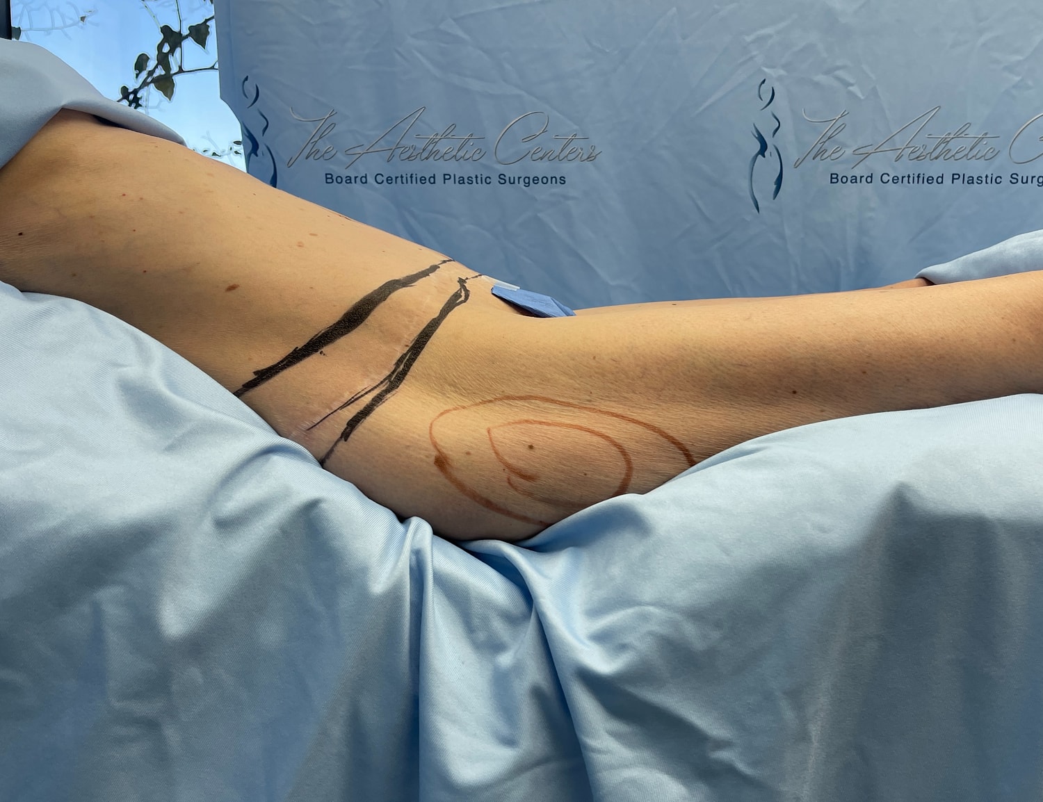 Patient prepped for surgical procedure on upper arm.