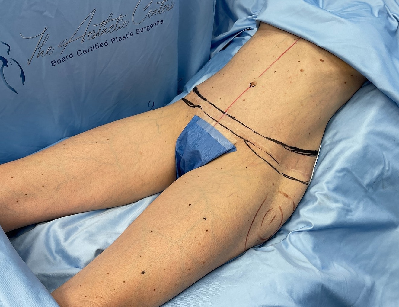 Patient preparing for plastic surgery procedure.