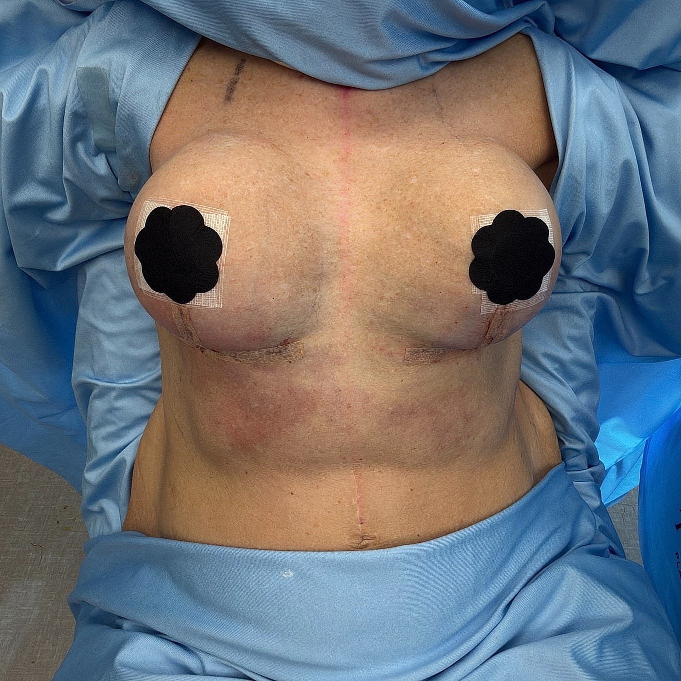 Post-surgery chest with bandages and draping.