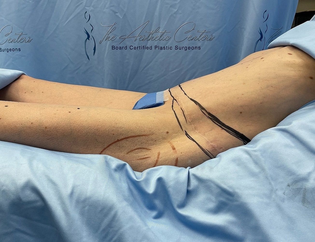 Surgical markings on patient's torso before procedure.