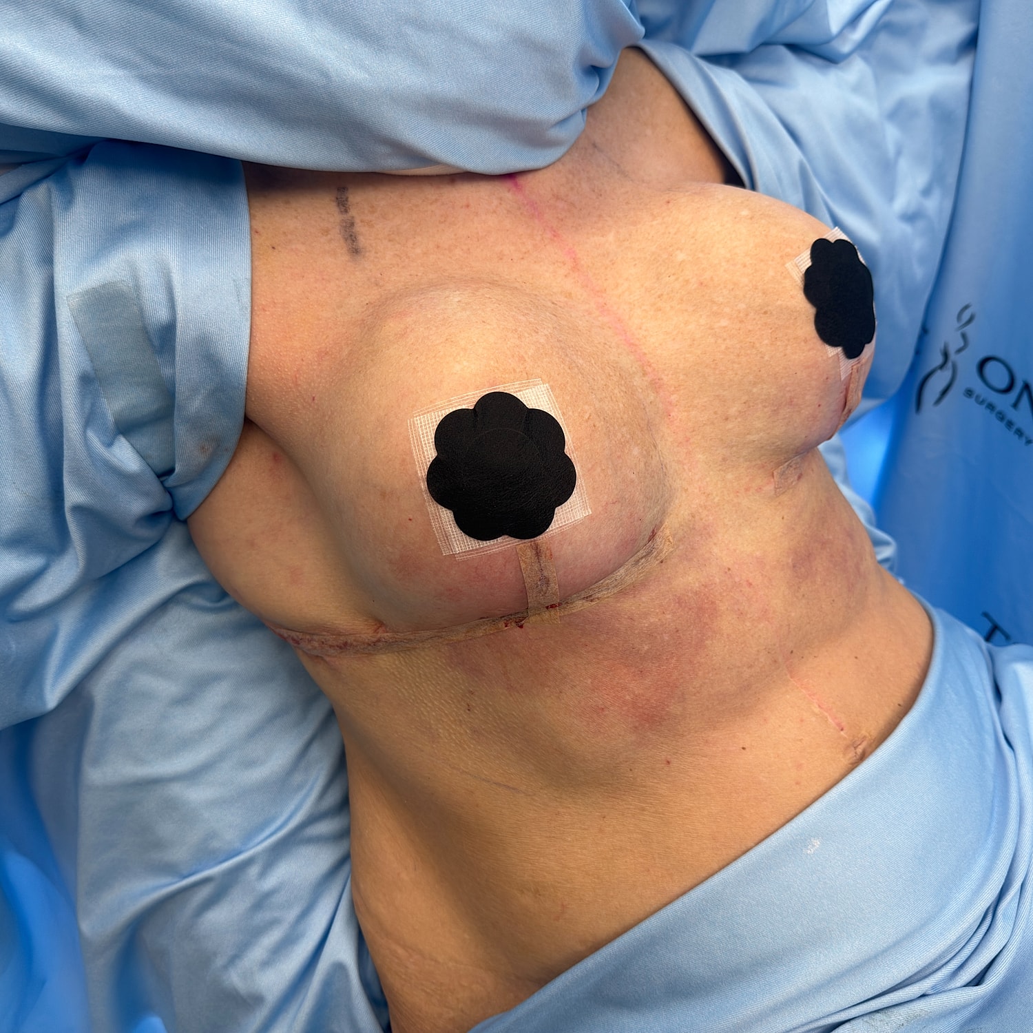 Post-surgery chest with bandages and coverings.