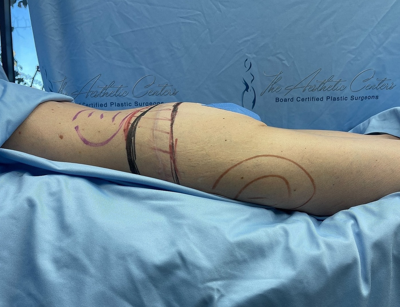 Patient’s leg marked for a cosmetic procedure.