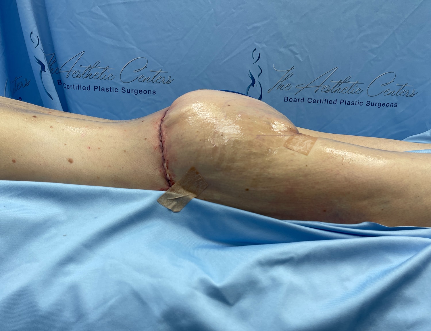 Surgical knee procedure post-operative recovery image.