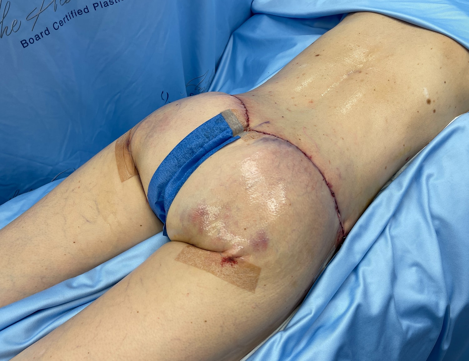 Post-operative surgical site on a patient's thigh.