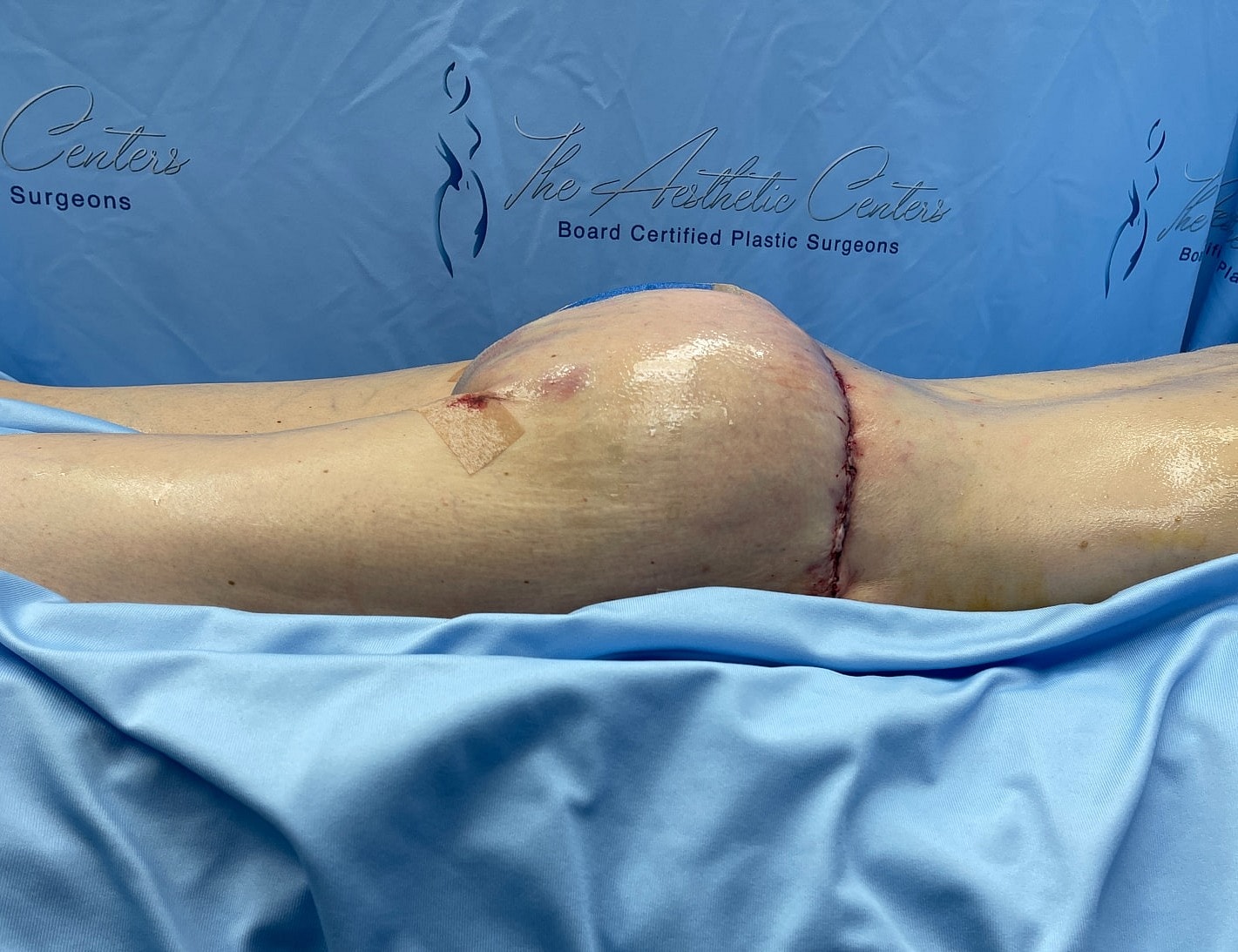 Patient post-surgery recovery with visible incision.