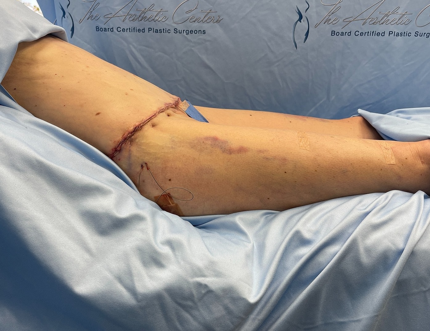 Post-surgery leg with visible incision and bruising.