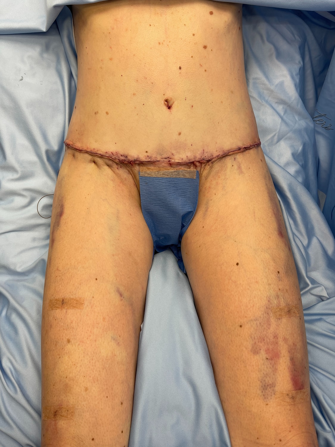 Post-operative abdomen and legs with stitches.
