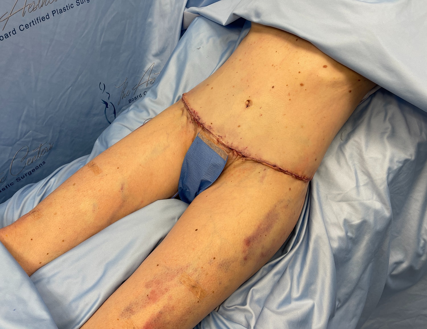Surgical site on abdomen with healing incisions.