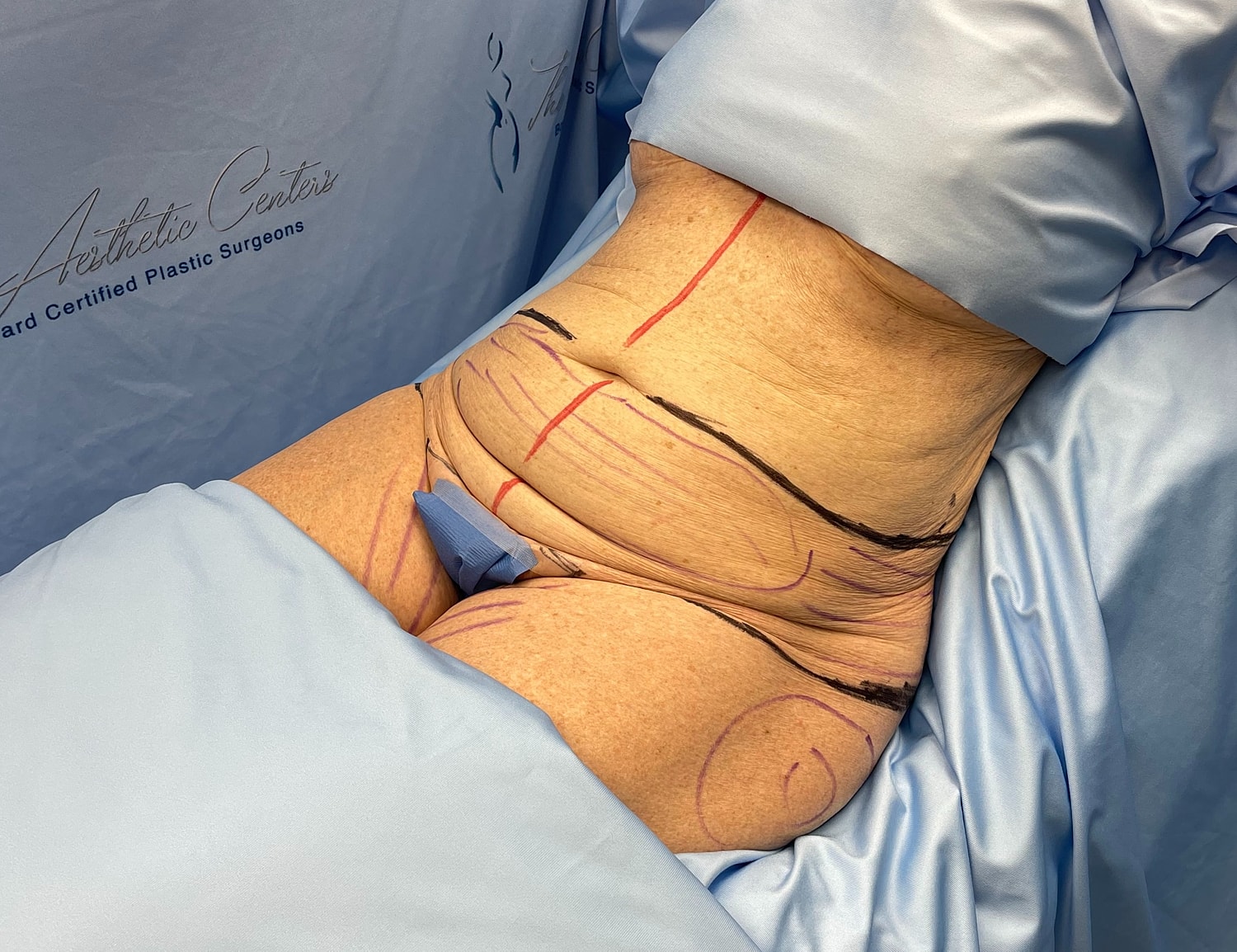 Patient preparation for body contouring procedure.
