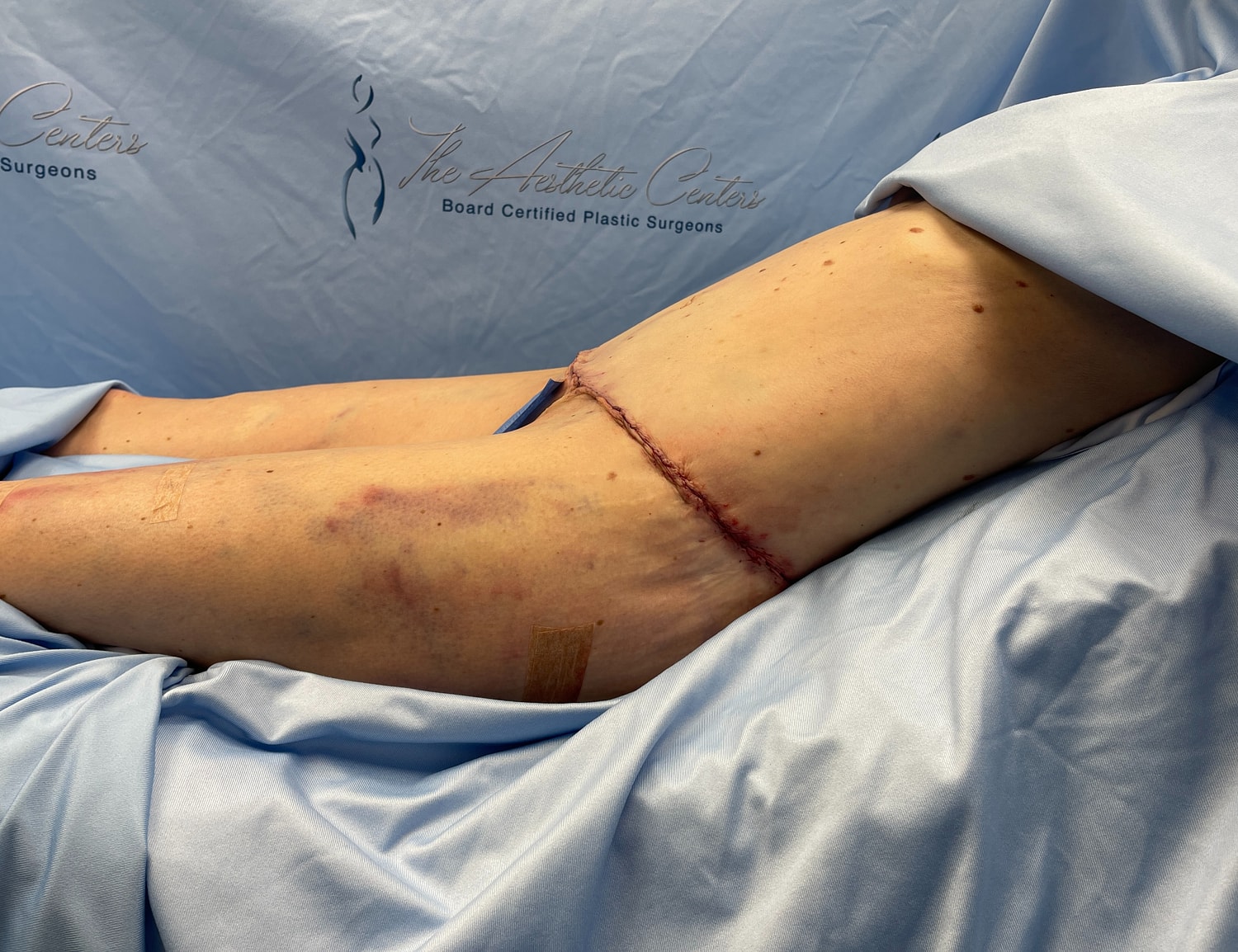 Surgical incision on patient’s thigh after procedure